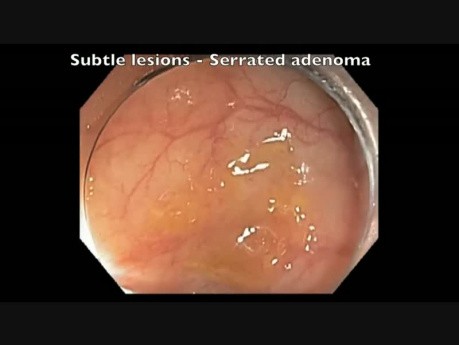 Colonoscopy Channel - Subtle Flat Lesion