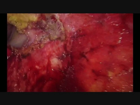 Diaphragm Resection and Reconstruction through a Single-Port VATS