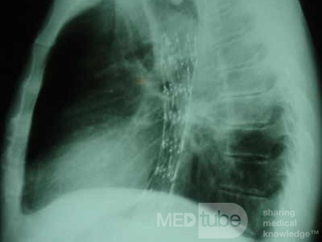 Esophageal Stent - X-ray