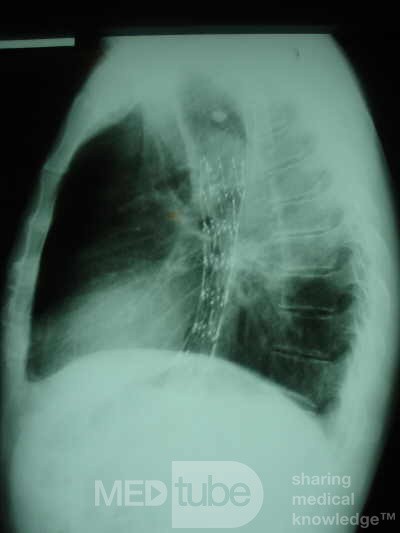 Esophageal Stent - X-ray