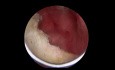 TURP - Abscess of the Prostate