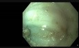 ESD - Rectum