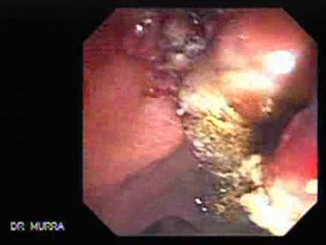 Adenocarcinoma of the Gallbladder (3 of 3)