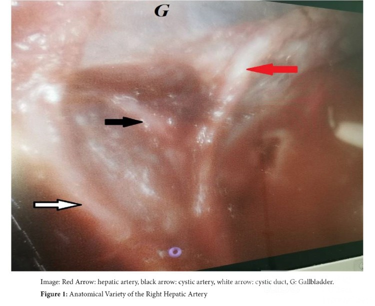 Rare Anatomical Variety of the Right Hepatic Artery