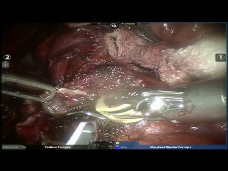 S2 Robotic Surgery