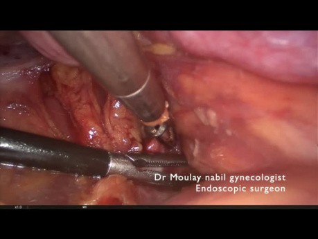 Internal Iliac Artery Ligation and Myomectomy