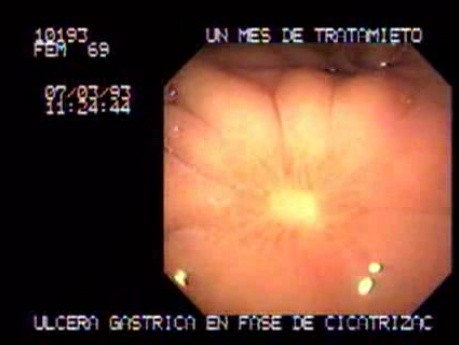 Large Gastric Ulcer (2 of 2)