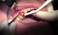 Flap Reflection & Pouch - Extraction #5 with Socket Bone Grafting - d-PTFE