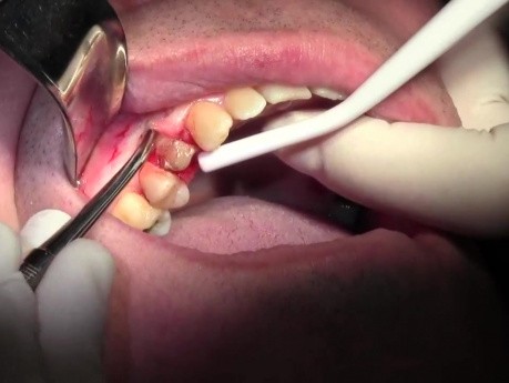 Flap Reflection & Pouch - Extraction #5 with Socket Bone Grafting - d-PTFE