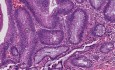 Tubular adenoma (adenomatous polyp) - Histopathology - Colon