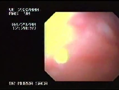 Long Segment of Barrett´s Esophagus.