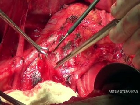 Open Para Aortic Lymphadenectomy