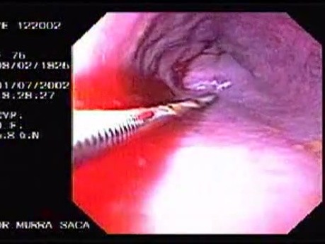 Hemorrhage due status post rubber band ligation of esophageal varices (12 of 25)