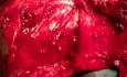 The Nape Of Neck Flap