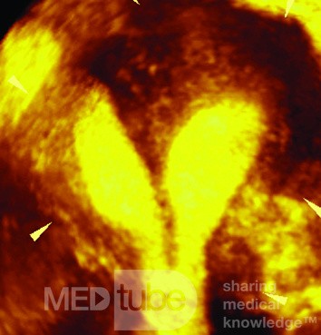 SEPTATE UTERUS BY THREE DIMENSION ULTRASOUND