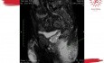MRI Pre and Post Treatment Horse Shoe Fistula in Ano with Ischirectal Abcess