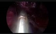 Uniportal VATS Bronchial B2-B3 Repair after Anatomic Segmentectomy S1