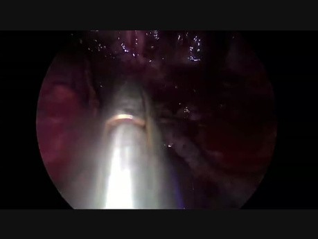 Uniportal VATS Bronchial B2-B3 Repair after Anatomic Segmentectomy S1
