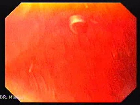 Brunner's Gland Hyperplasia (1 of 3)
