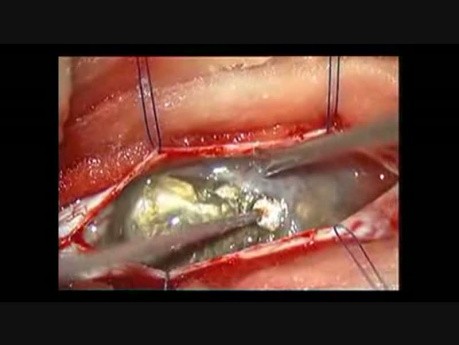 Spinal Intra Dural Epidermoid - Microsurgical Removal