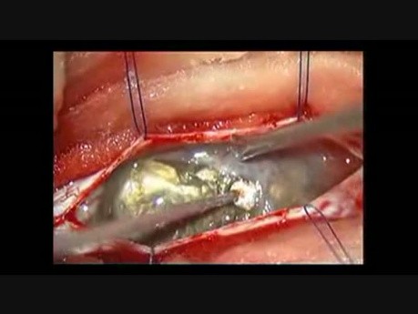  Spinal Intra Dural Epidermoid - Microsurgical Removal