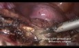 Total Laparoscopic Hysterectomy for Huge Uterus -Tips and Tricks