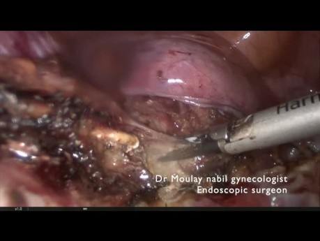 Total Laparoscopic Hysterectomy for Huge Uterus -Tips and Tricks