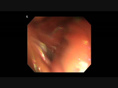 ESD For Gastric SMT