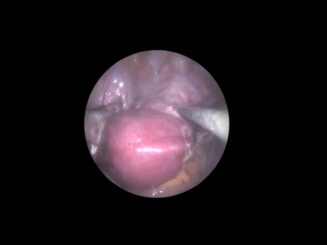 SELS - 8.5mm Single Port Hysterectomy