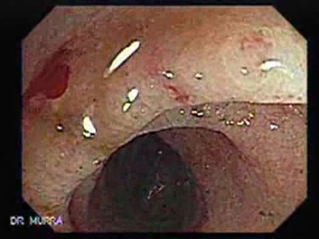 Radiation Enteritis (3 of 4)