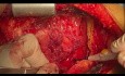 Patient with Constrictive Pericarditis and Malignant Mesothelioma Undergone CABG and Pericardiectomy 