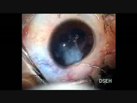 Another Case of Traumatic Cataract with PC Rupture