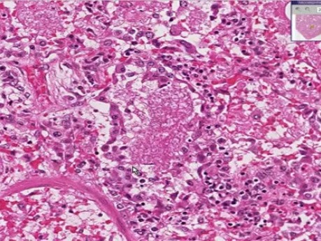 Pneumocystis pneumonia