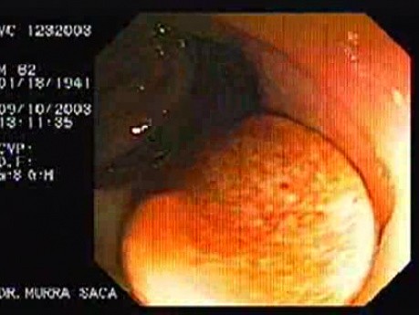A Tablet of Medicine in the Colon (1 of 2)