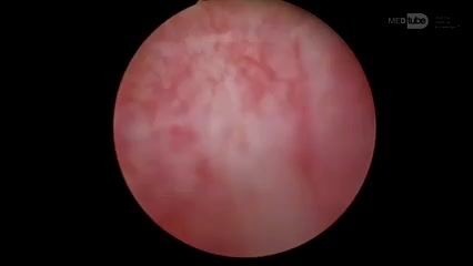 PVP Large Prostate 