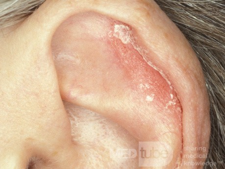 Psoriasis Pinna