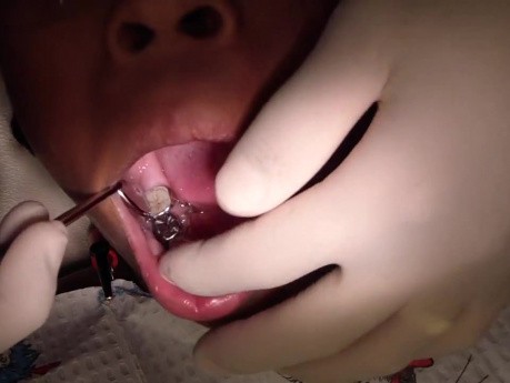 Lingual Arch Debonded