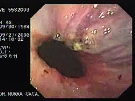 Acute Variceal Bleeding - Necrotic Area