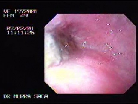 Esophageal Achalasia - a 49 Year-Old Female