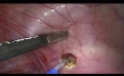 Endometriosis