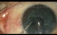Capsular Tension Ring Before Hydro Procedures in Subluxated Traumatic Cataract