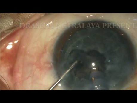 Capsular Tension Ring Before Hydro Procedures in Subluxated Traumatic Cataract