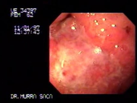 Adenocarcinoma of the Antrum