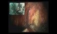 Robotic prostatectomy in HD - DaVinci Surgery - part 1