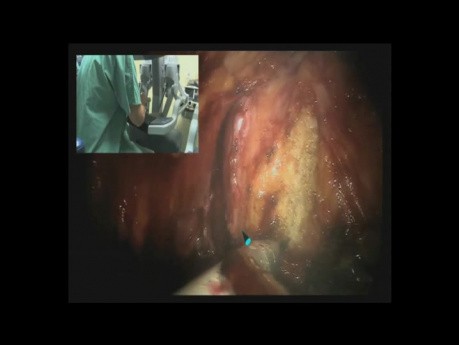 Robotic prostatectomy in HD - DaVinci Surgery - part 1