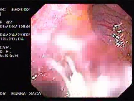 Crohn's Disease - Endoscopy (7 of 28)