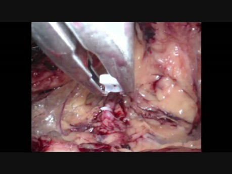  Laparo-Endoscopic Single Site Surgery (LESS)