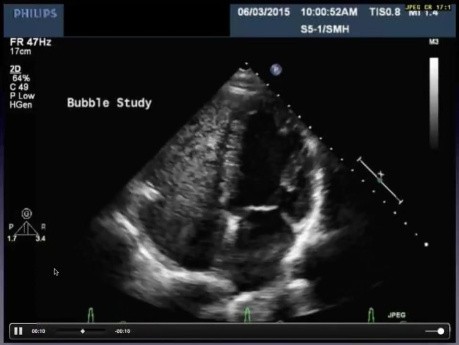 Deciphering the Mystery of Agitated Saline Contrast