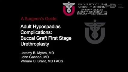 Staged Urethroplasty for Urethral Stricture from Failed Hypospadias Surgery