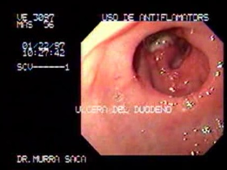 Duodenal Ulcer in Deformed Bulb